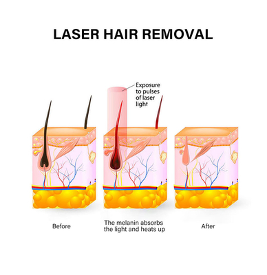 Tragbare Laser-Haarentfernungsanlage 810nm Dauerhaarentfernungsanlage für Frauen