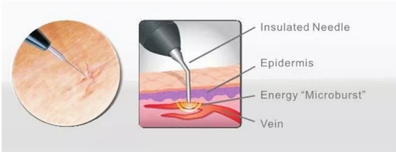 Schönheitssalon 980nm Diodenlasermaschine zur Schmerzlinderung / Gefäßbehandlung