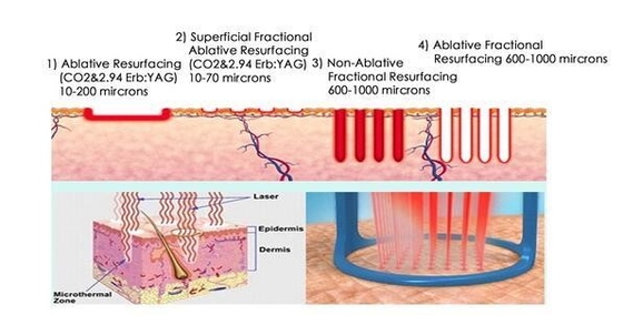 Narbenentfernung Fraktions-CO2-Laser-Schönheitsgerät mit 10,4 Zoll LCD-Touchscreen