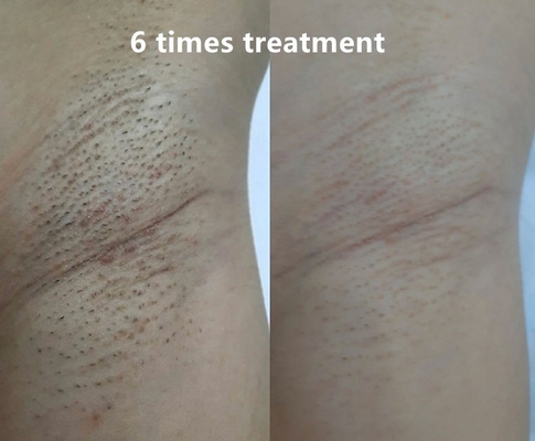 4 Wellenlängen Dioden Laser Haarentfernung Maschine 808nm/755 808nm 1064nm mit Benutzerhandbuch