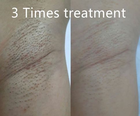 Multifunktionales Dioden-Laser-Haarentfernungssystem mit unterschiedlichen Pulsbreiten für eine maßgeschneiderte dauerhafte Haarverkleinerung