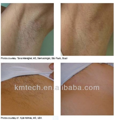 Professionelle Klinik Laser-Haarentfernung Maschine Diode 3 Wellen KM960D