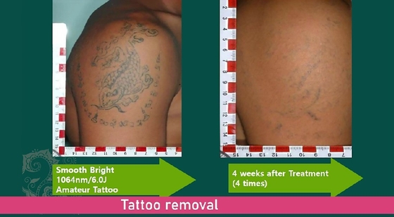 Picosecond Laser Gesichtsverjüngungsmaschine, Q Switched Tattoo Entfernung Maschine