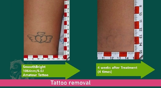 Kommerzielle Q-Switched Laser Tattoo Entfernung Maschine 1064nm 532nm 755nm