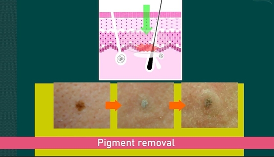 755nm Picosecond Laser Maschine für Haarentfernung / Tattoo Entfernung Englische Sprachen Option