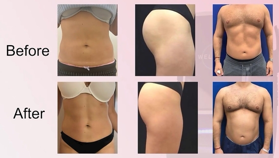 Desktop EMS Schlankheitsmaschine Professionelle Cellulite-Maschine für Hautpflege