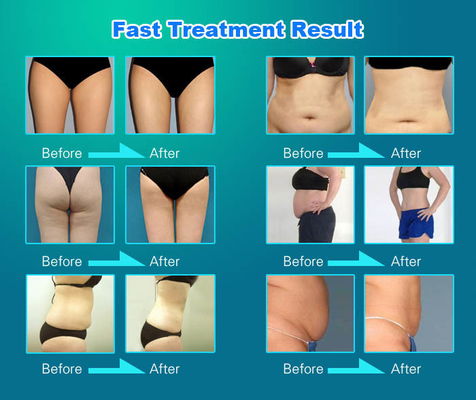 Maschine zur Entfernung von Körpercellulite