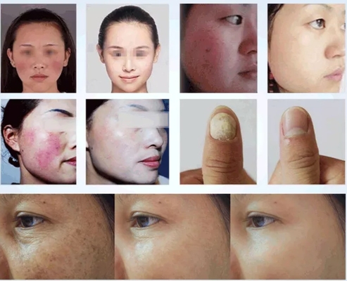 50W 980 Nm Diodenlaser Spinnenvenenentfernung für Blutgefäßbehandlung