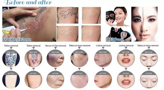 Portable Nd YAG Laser Tattoo Entfernung Maschine 1064nm 532nm 1320nm Wellenlänge