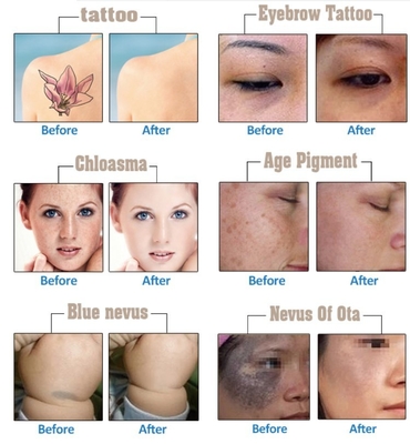 Q Switch Nd YAG Laser Tattoo Entfernung Maschine 1064nm 532nm 1320nm 2 Jahre Garantie