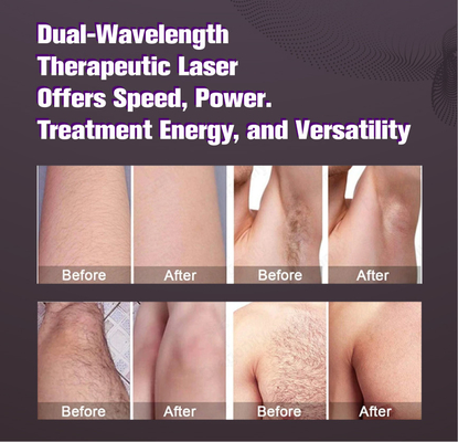 Großflächengroße Kerzenlaser-Alexandrit-Haarentfernung Weißhaar-REMOVAL 2000w-Alexandrit-Laser-Gerät