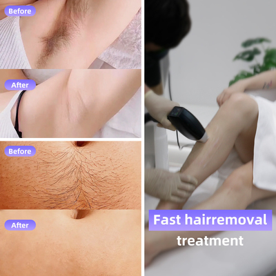 808 Diode Laser Eis Haare Entfernen Maschine 4 Wellenlängen 1064nm Wechselbare Fleckengröße Android-System
